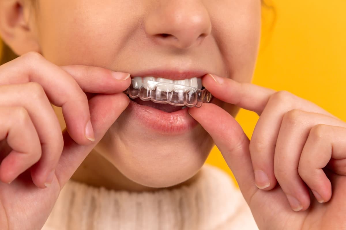 Clear Aligners in Queens Village